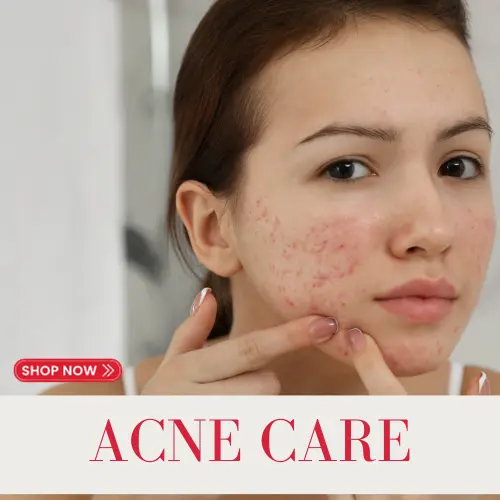 Donkey milk acne cream