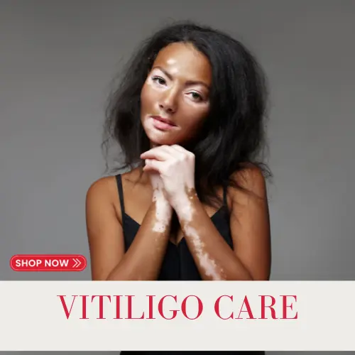 donkey milk vitiligo treatment