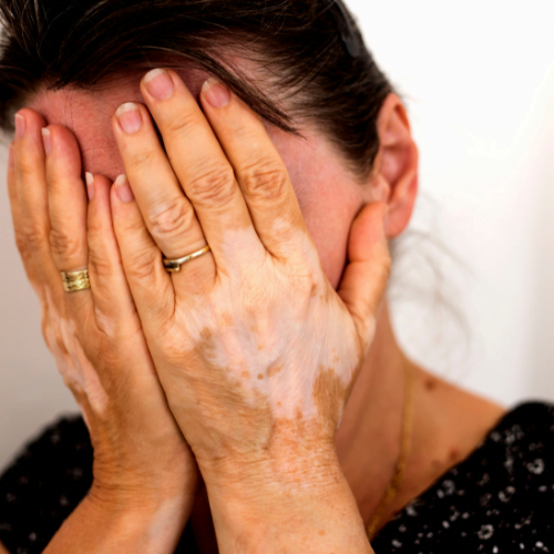 vitiligo pictures